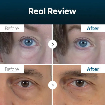 ⭐Ultimate Under‑Eye Lift & Brighten Cream – Eyebag Erase