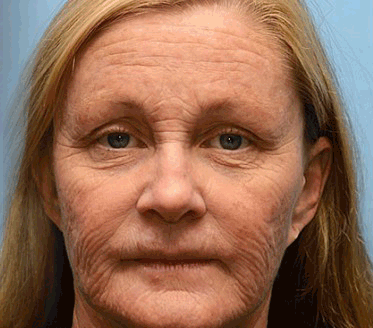 𝑶𝒇𝒇𝒊𝒄𝒊𝒂𝒍 𝑺𝒕𝒐𝒓𝒆👍| Regain youthful skin nown 💫LOVILDS® BOTOX & VITA A RETINOL SHOT Wrinkle Lift Tightening Cream